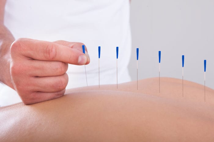 az akupunktúra enyhíti a fájdalmat