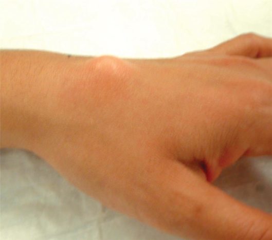 A felső csukló csuklós ganglion cista (forrás: American Society for Surgery of the Hand)