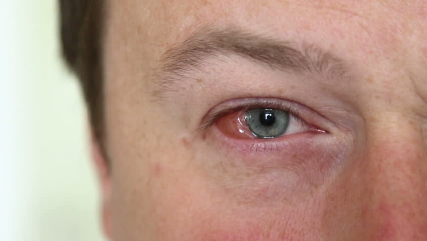 szemészeti herpesz szem