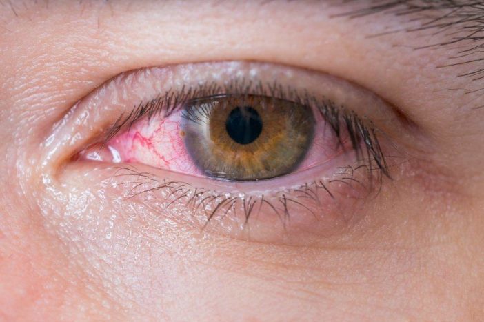 allergiás vörös szemek kötőhártya-gyulladása