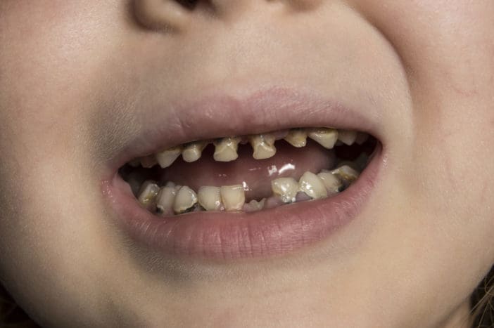 bébi üveg fogszuvasodás a gyermekek fogszuvasodásához
