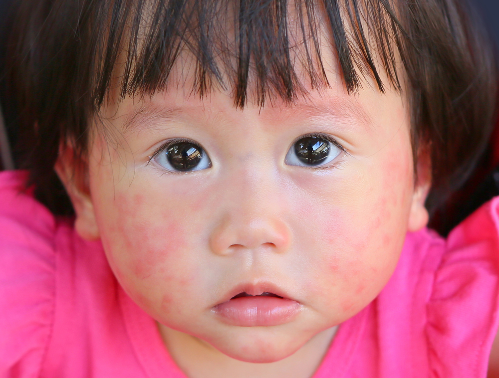 a tehéntejre allergiás babák jellemzői