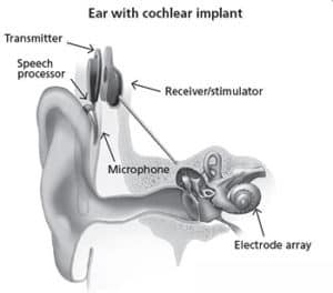cochlearis implantátum eszköz