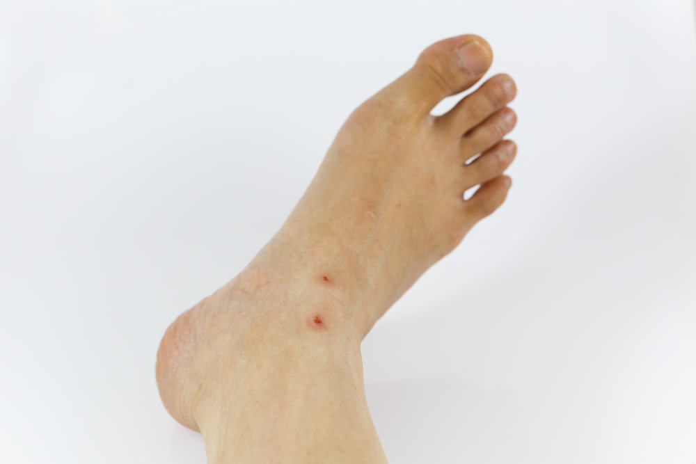 Mint kezelni bőrpír a lábát a cukorbetegség típusú foltok, kezelés