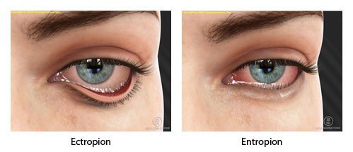 a szemhéj-rendellenességek ektropionja