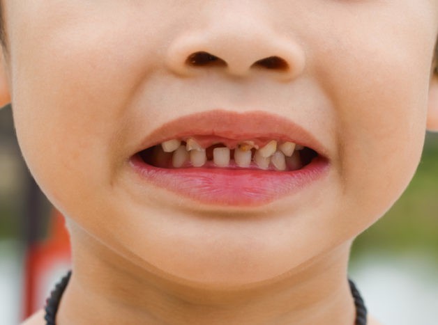 a gyermekek fogainak károsodása