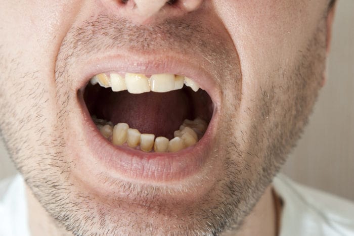 hogyan lehet megakadályozni a fogkő