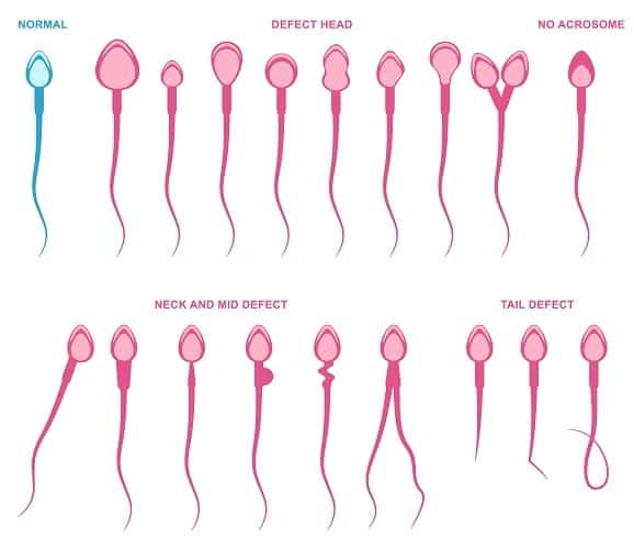 spermiumok rendellenességei